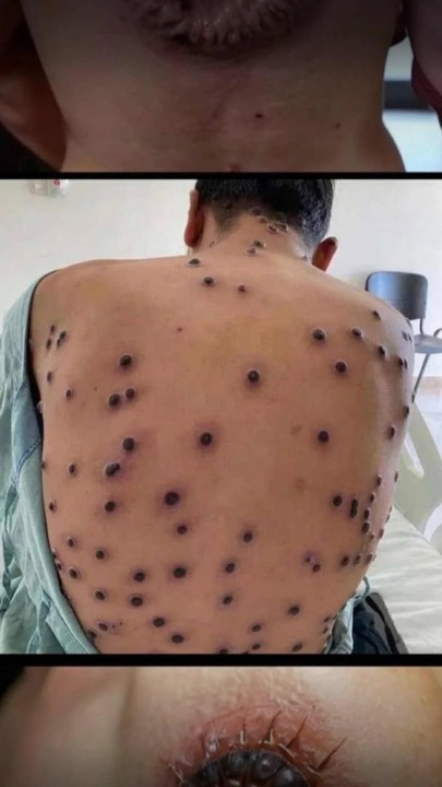 Effective Ways to Manage and Treat Back Acne: A Complete Guide