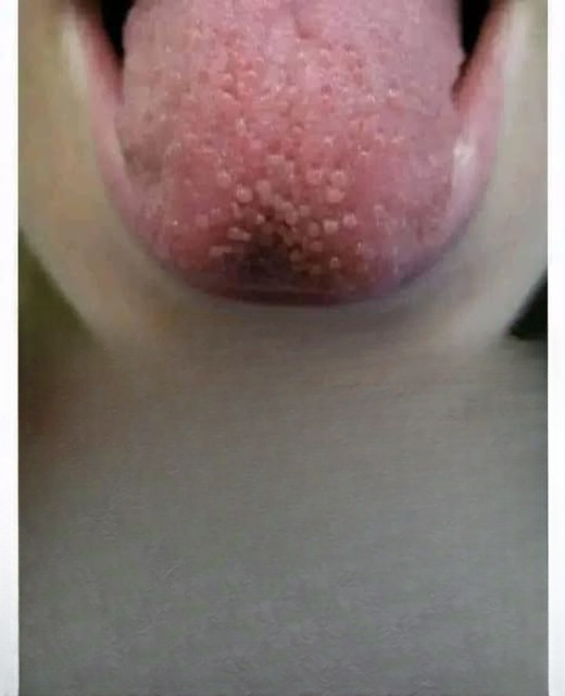 What Your Tongue is Trying to Tell You: 4 Common Tongue Symptoms That Reveal Clues About Your Health