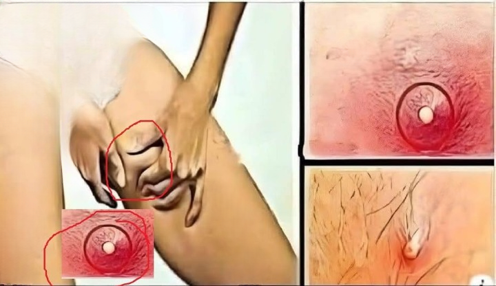 Inner Thigh Bumps: Causes, Home Care Tips, and Prevention Strategies