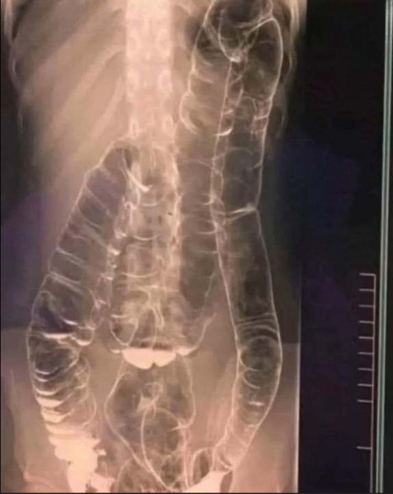 Chronic Constipation: The Hidden Threat to Digestive Health You Shouldn’t Ignore
