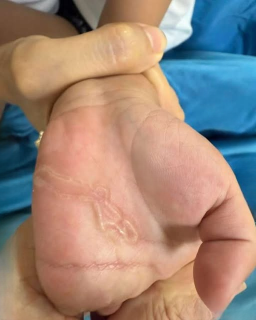 A Four-Year-Old’s Mysterious Hand Marks Reveal a Hidden Parasitic Threat