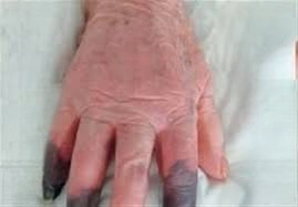 When Infections Go Untreated: The Serious Warning Signs