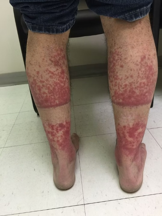 Exercise-Induced Vasculitis: Causes, Symptoms, and Relief for Heat-Triggered Leg Rashes
