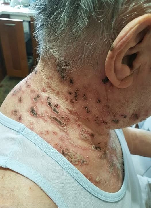 The “Silent” Disease That Can Reactivate Without Warning: Understanding Shingles and Why Timing Matters